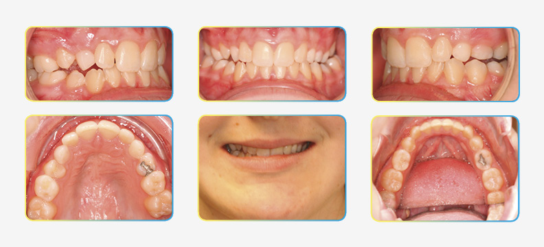 Intial orthodontic photos