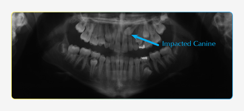 Inital Orthodontic panoramic X-ray showing impacted canine and premolar