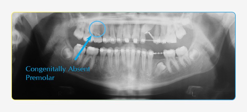Panoramic X-ray image showing exposed canine