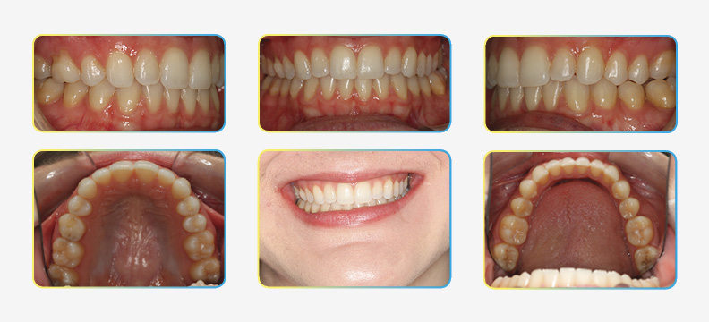 Final Orthodontic treatment photos