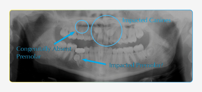 Panoramic X-ray displaying 2 impacted canines