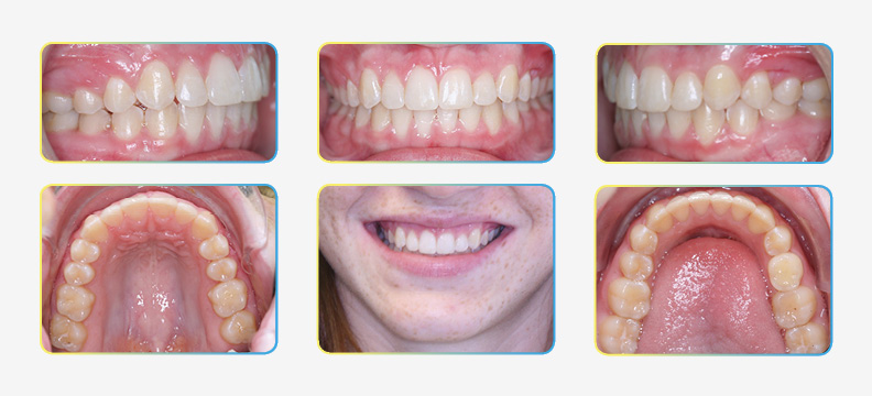 Final Orthodontic Photos