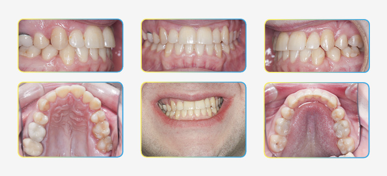 final photos after orthodontic extraction treatment