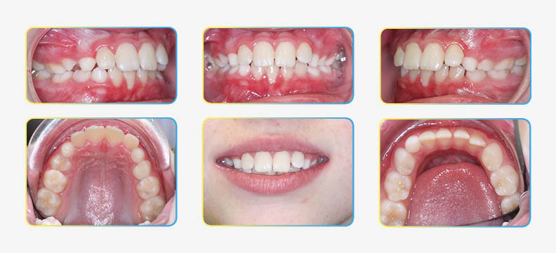 first orthodontic visit photos
