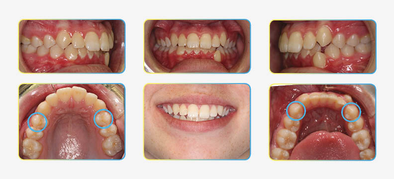 Orthodontic photos before extractions
